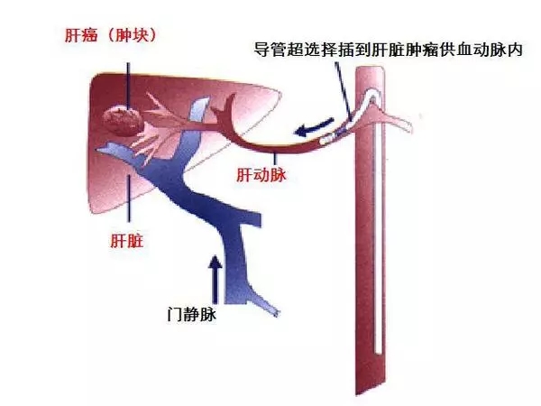 经肝动脉化疗栓塞示意图