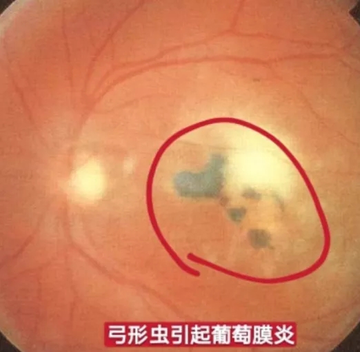 幼年型慢性关节炎伴发的葡萄膜炎,青年人多发特发性急性前葡萄膜炎