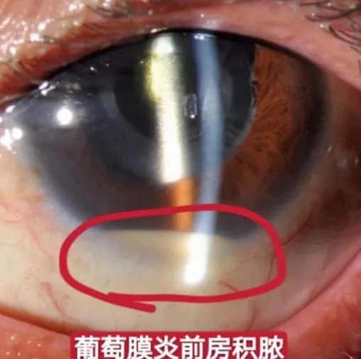 眼病葡萄膜炎很危险,跟"葡萄"有关么?