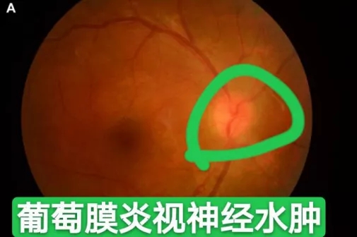眼病葡萄膜炎很危险,跟"葡萄"有关么?