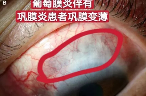 眼病葡萄膜炎很危险跟葡萄有关么