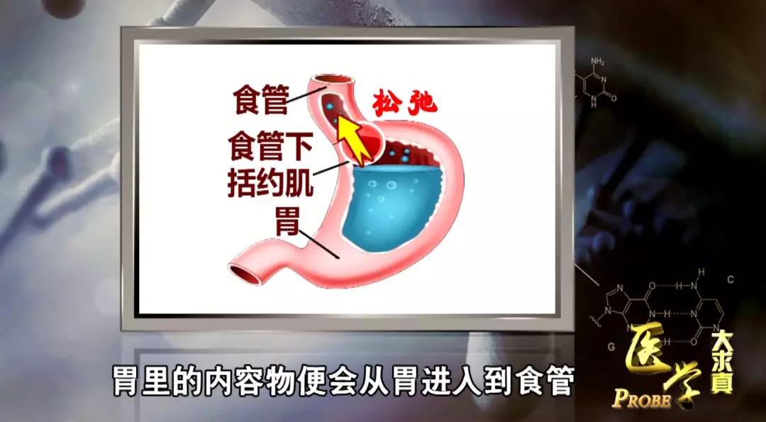 天津医科大学总医院 新闻中心 健康讲堂  胃食管反流病会随着年纪越高