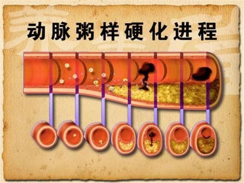 疏通血管软化血管吃什么好_想血管通畅软化多吃什么好_八种食物疏通软化血管
