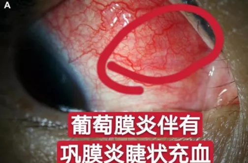 症状体现不同年龄段均可发生葡萄膜炎,青壮年尤为多见.